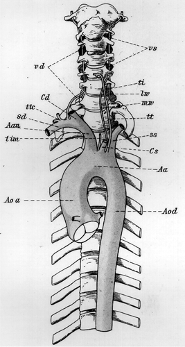 Image of a rare variation of vertebral artery