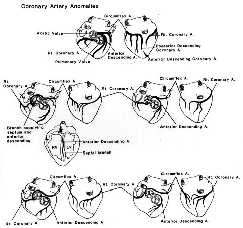 Image of coronary artery variations