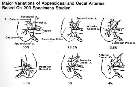 Image of major variations of appendiceal and cecal arteries