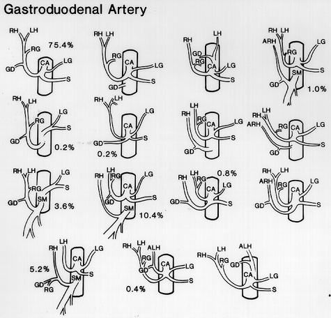 Image of variations in origin of gastroduodenal artery