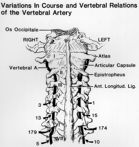 Image of variations in course and vertebral relations of the vertebral artery