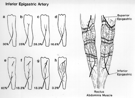 Image of variation in form of the inferior epigastric artery