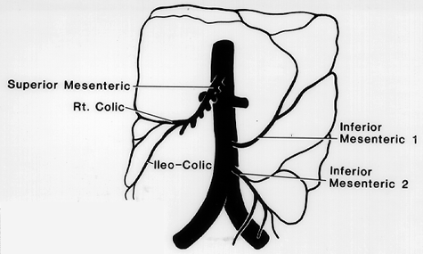 Image of doubled inferior mesentric artery