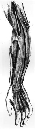 Image of high origin of ulnar artery