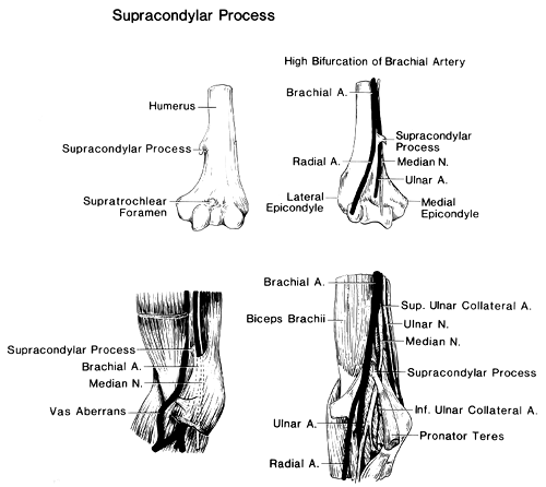 Image of supracondylar process, ligament of struthers, and the brachial artery