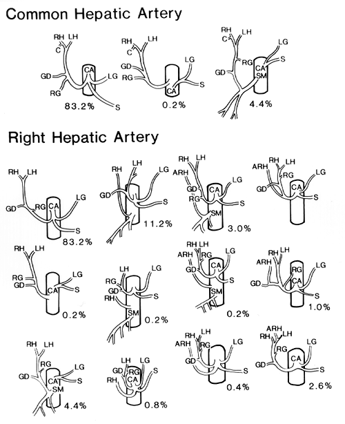 Image of variations in origin of common hepatic artery and variations in origin of right hepatic artery