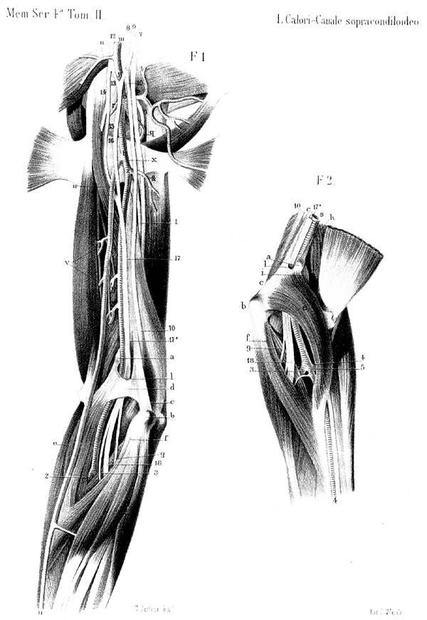 Image of anomalous high division of axillary artery into radial and ulnar artery branches