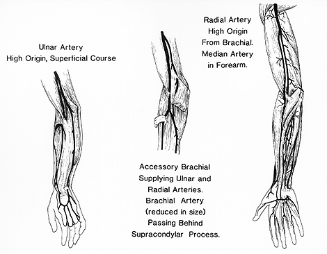 Image of accessory brachial, radial and ulnar arteries and persistent median artery