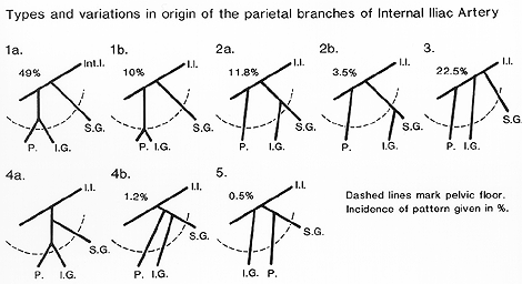 Image of variation in origin of the parietal branches of interal iliac artery