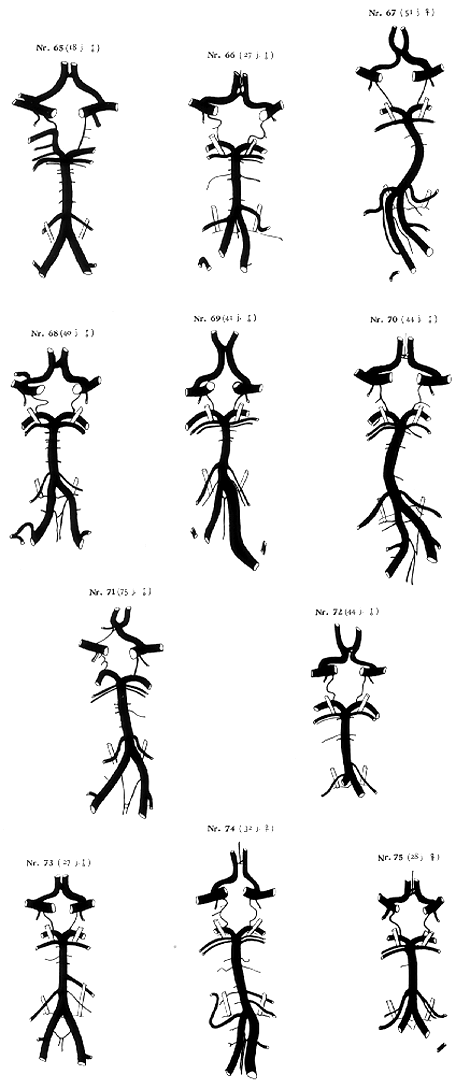 Image of variations of circle of Willis