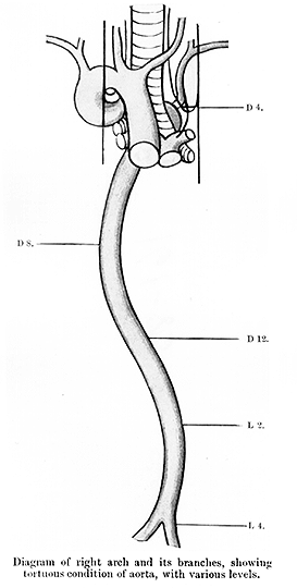Image of tortuous aorta