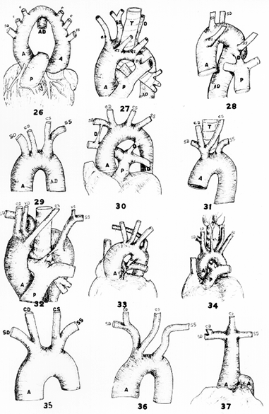 Image of aortic arch variations