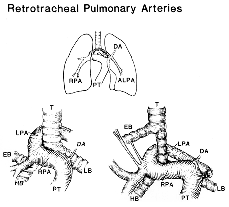 Image of retrotracheal pulmonary arteris and anomalous origin of left pulmonary artery