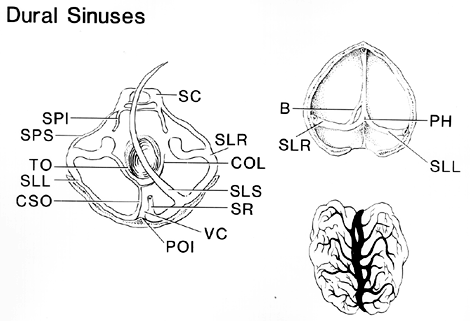 Image of absence of confluens of dural sinuses