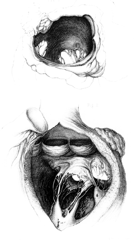 Image of doubled mitral valve
