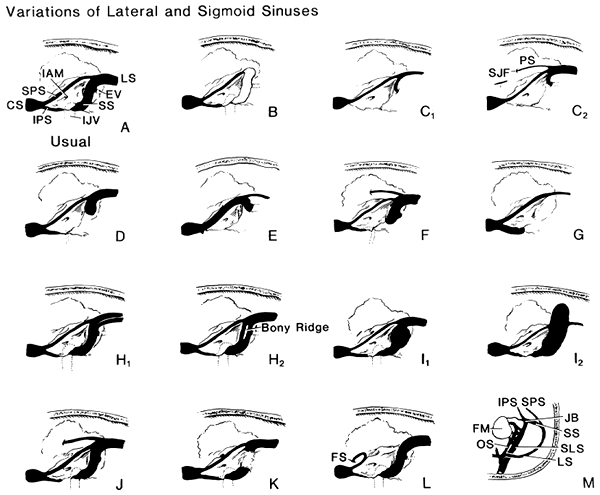 Image of variation in lateral and sigmoid sinuses