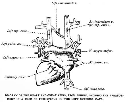 Image of Heart with persistent superior vena cava