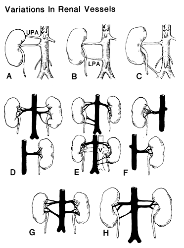 Image of renal vessel variations