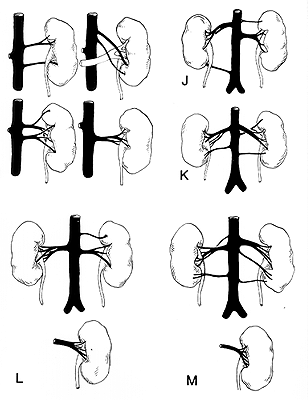 Image of renal vessel variations