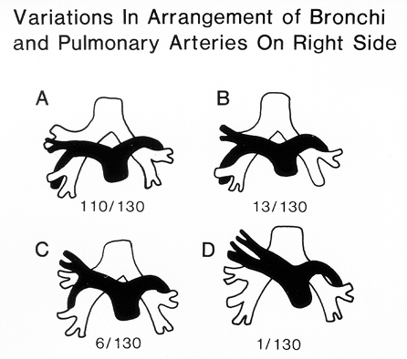 Image of arrangement of bronchi and pulmonary arteries