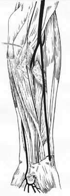 Image of median artery from radial artery