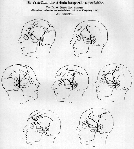 Image of superficial temporal artery variations in the superficial artery
