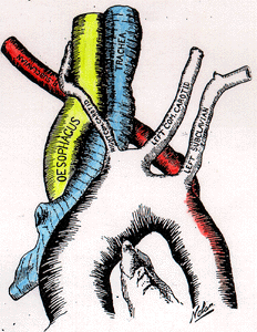 Image of retroesophageal right subclavian artery