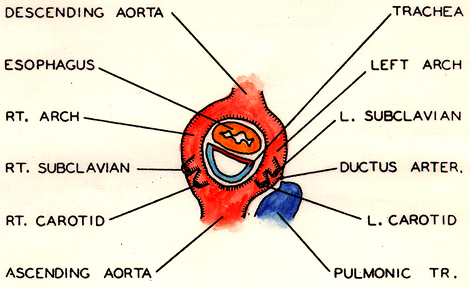 Image of symmetrical double aortic arch