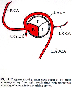 Image of left main coronary artery from right aortic sinus with retroaortic course
