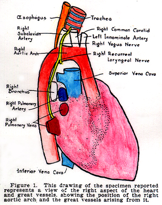 Image of right aortic arch