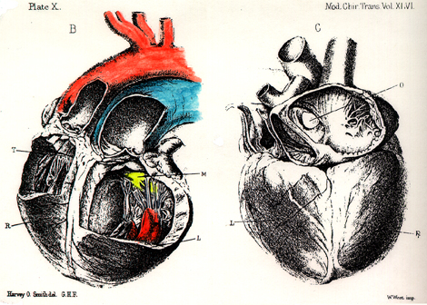 Image of mitral valve with three cusps
