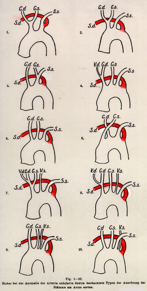 Image of types of retroesophageal right subclavian arteries