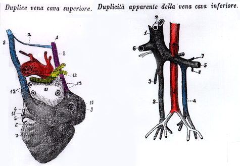 Image of doubled superior and doubled inferior vena cava