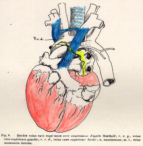 Image of doubled superior vena cava after Marshall