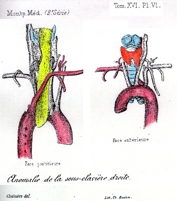 Image of right subclavian