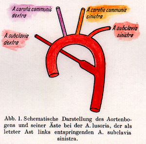 Image of arteria lusoria