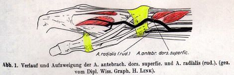 Image of rudimentary radial artery