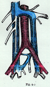Image of peristent inferior vena cava