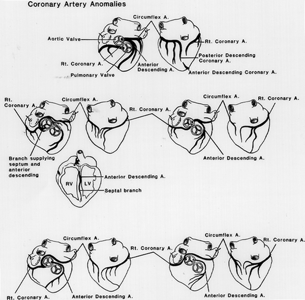 Image of varian coronary arteries