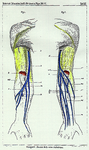 Image of absence of cephalic vein