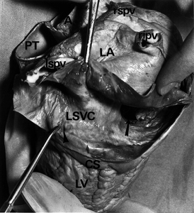 Image of the human persisten left superior vena cava with doubled coronary sinus