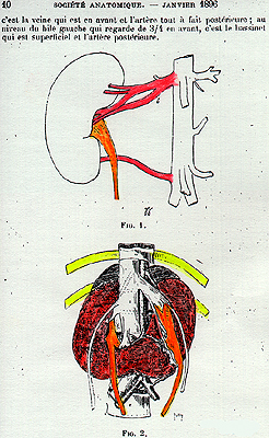 Image of renal artery variation and a horseshoe kidney
