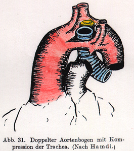 Image of double aortic arch