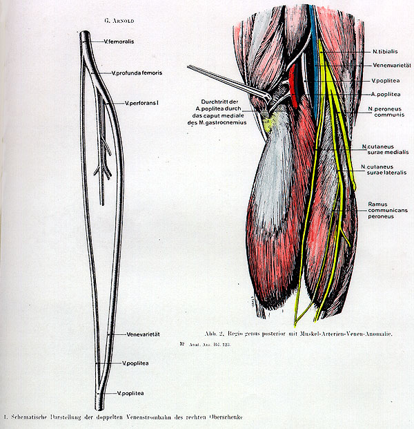 Image of popliteal artery and vein trapped in the medial head of gastrocnemius