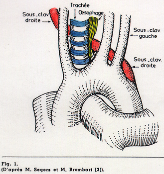 Image of retroesophageal subclavia dextra