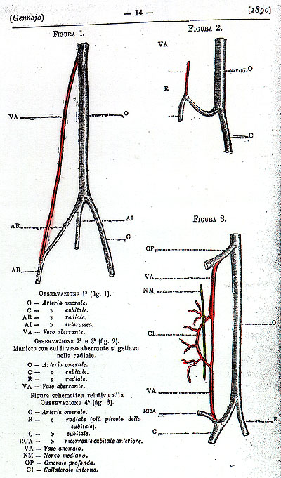 Image of arteria aberrans of the brachial artery