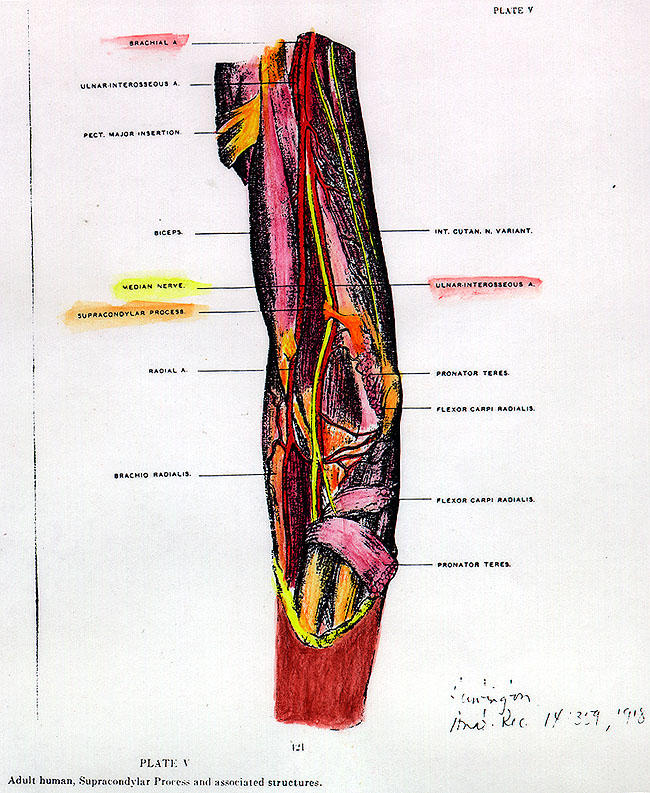 Image of high origin of radial artery with an ulnar-interosseous artery passing through a supracondylar canal