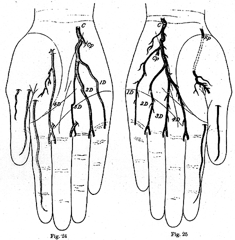 Image of some variations in deep palmar arch