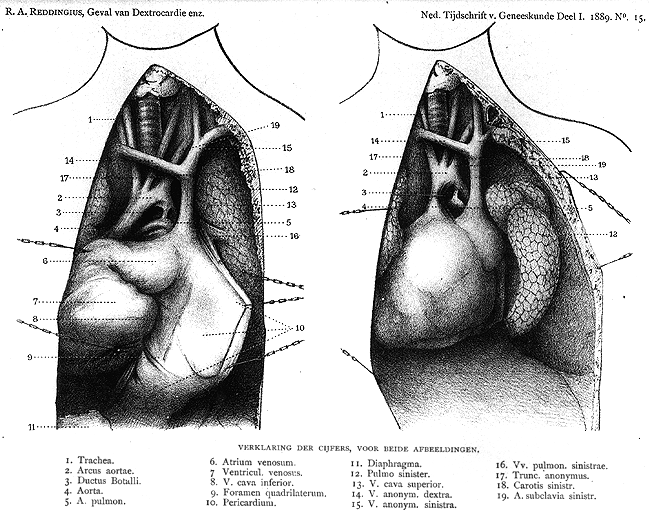 Image of right-sided heart