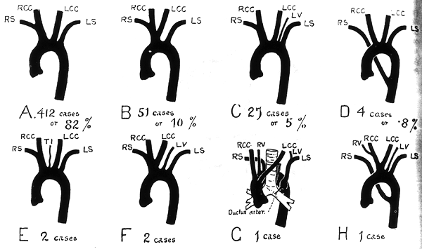 Image of variations in mode of origin of branches of aortic arch